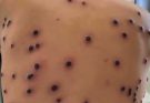ST1 – Their Acne As Severe (MonkeyPox)