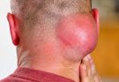 Surgical Aperture of Abscess in the neck region