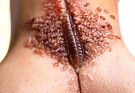 STiv – Their Acne As Severe