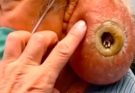 STVIV – Their Acne As Severe